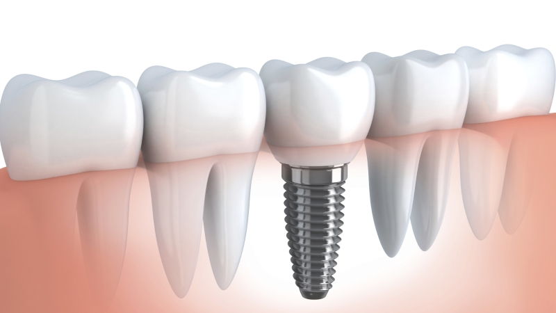 Implantes dentales en Margarita - Implantología de prótesis dentales